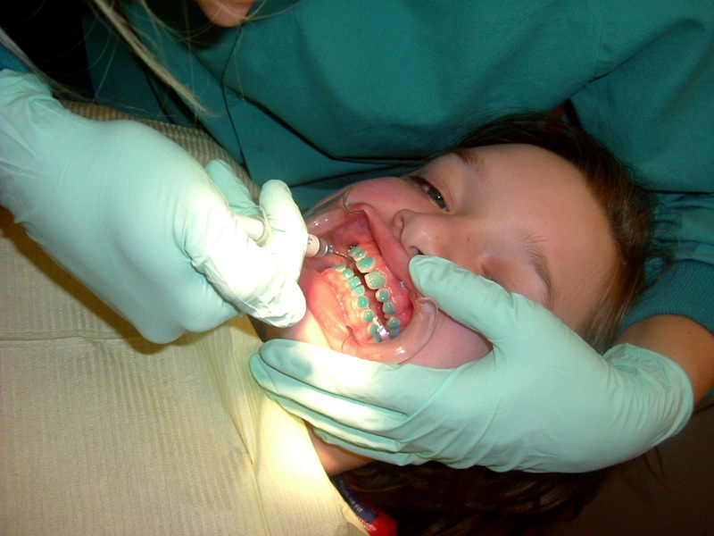 Ceramic Orthodontic Braces